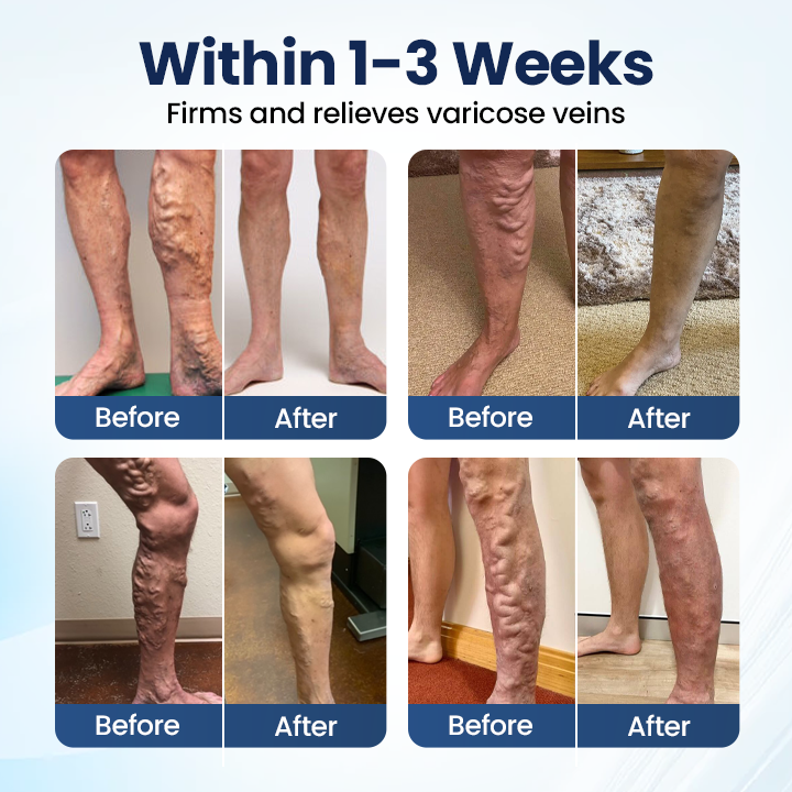 🔥LAST DAY 70% OFF-Alcuras® Deep Vein Repair Microneedle Patch