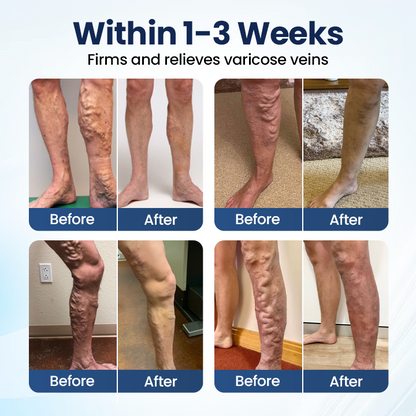 🔥LAST DAY 70% OFF-Alcuras® Deep Vein Repair Microneedle Patch