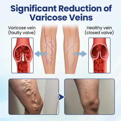 🔥LAST DAY 70% OFF-Alcuras® Deep Vein Repair Microneedle Patch