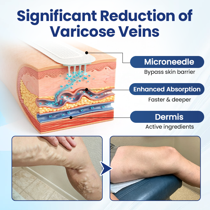 🔥LAST DAY 70% OFF-Alcuras® Deep Vein Repair Microneedle Patch