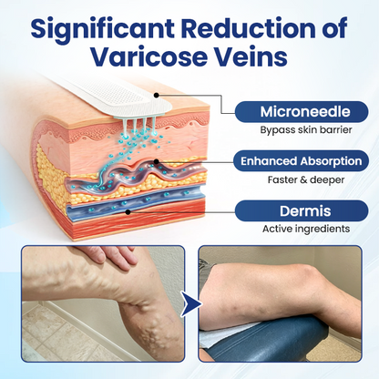 🔥LAST DAY 70% OFF-Alcuras® Deep Vein Repair Microneedle Patch