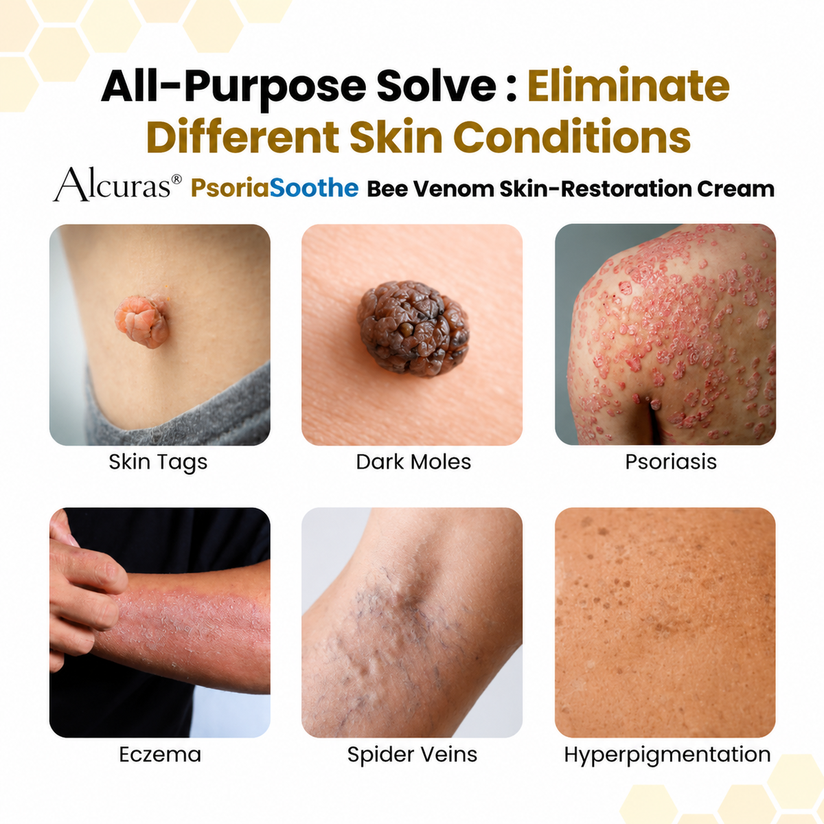 Alcuras® PsoriaSoothe Bee Venom Skin-Restoration Cream