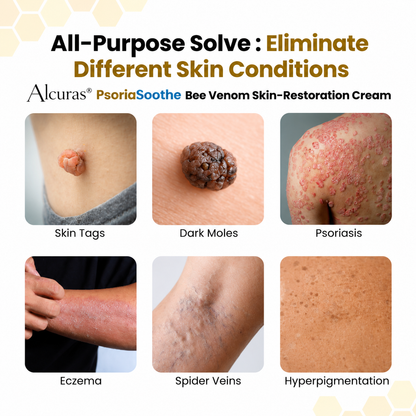 Alcuras® PsoriaSoothe Bee Venom Skin-Restoration Cream