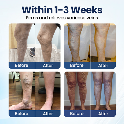🔥LAST DAY 70% OFF-Alcuras® Deep Vein Repair Microneedle Patch