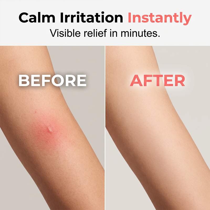 Portable Mosquito Insect Bite Relieve Itching Pen